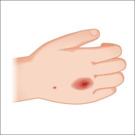 図3　手背への点滴固定によるMDRPUのイメージ