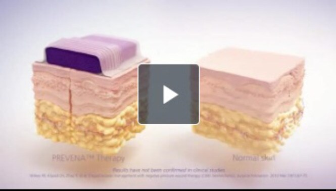 3M™ Prevena™ 切開創管理システムの作用機序について
