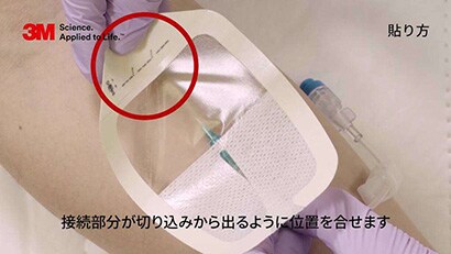 末梢静脈カテーテルの固定３動画
