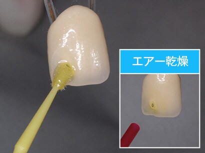 4. スコッチボンド™ ユニバーサルの塗布

