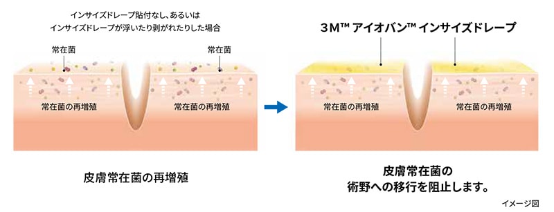 3M™ アイオバン™ スペシャル インサイズドレープは、皮膚常在菌の術野への移行を物理的に阻止します。