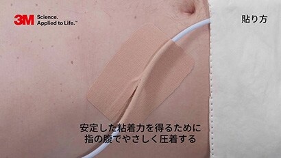 膀胱留置カテーテルの固定方法
