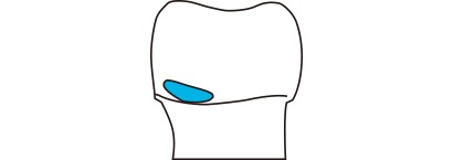 ポーセレンの破折修理 （小さな部分）
