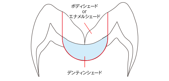  臼歯部咬合面に充填されたアマルガムやメタルインレーをCRで置き換える症例は、患者さんの審美的な満足度も高く、2～3シェードで修復できるので自費CRの最適症例
