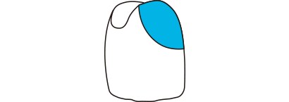 テンポラリークラウンの修復
