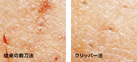 従来の剃毛法とクリッパー法の違い