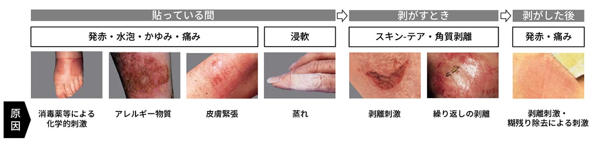 皮膚 剥離 と 表皮 剥離 の 違い