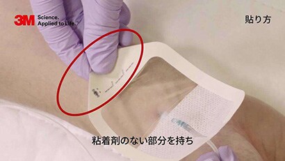 末梢動脈カテーテル（Aライン）の固定２動画
