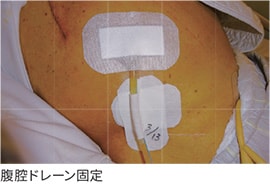 腹腔ドレーン固定
