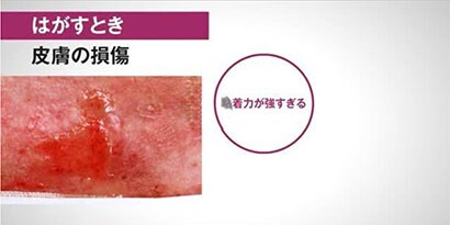 動画で学ぶ　サージカルテープの正しい貼り方・剥がし方
