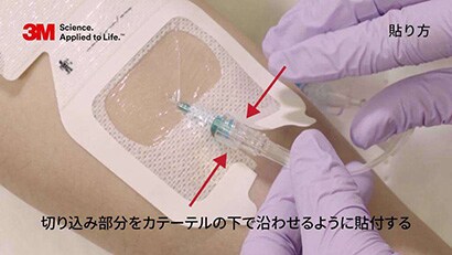 末梢静脈カテーテルの固定２動画
