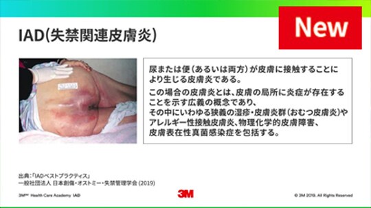 IAD(失禁関連皮膚炎)について
