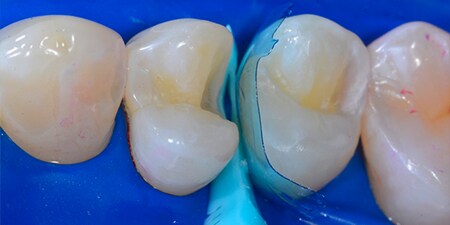 2：2級窩洞修復での単独での最終修復材料として
