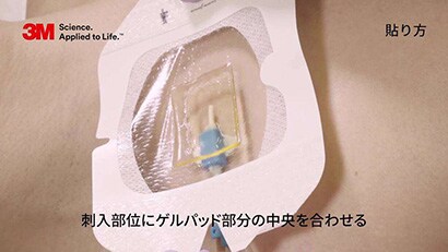 中心静脈カテーテルの固定（クロルヘキシジン含有ドレッシングを用いた例）２
