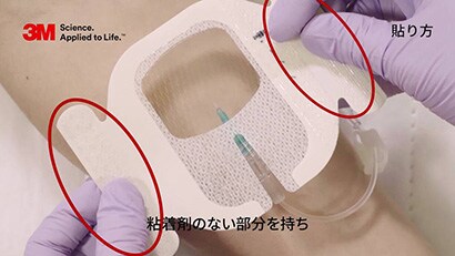 末梢動脈カテーテル（Aライン）の固定動画
