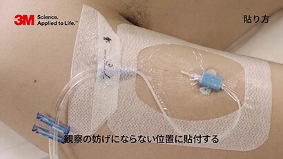 PICCカテーテルの固定動画
